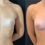 nps_before-after-tuberous-breasts-1-min