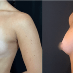 nps_before-after-tuberous-breasts-2-min