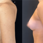 nps_before-after-tuberous-breasts-3-min