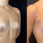 nps_before-after-tuberous-breasts-4-min