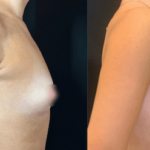 nps_before-after-tuberous-breasts-5-min