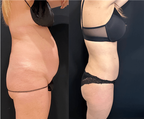nps_before-after-tummy-tuck-3.12-min