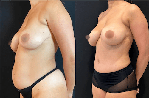 nps_before-after-tummy-tuck-3.20-min