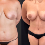 nps_before-after-tummy-tuck-2-4-min