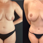 nps_before-after-tummy-tuck-4-min