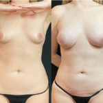 nps_before-after-tuberous-breasts-augmentation-min