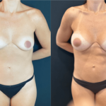 nps_breast-augmentation-12-min