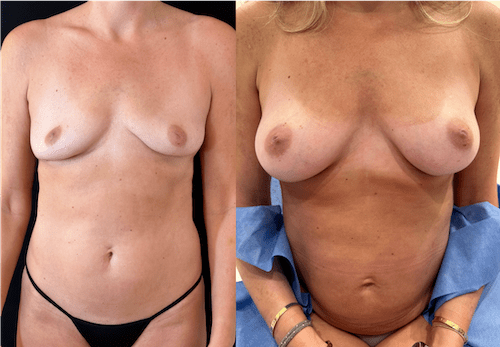 nps_breast-revision-case-14-min