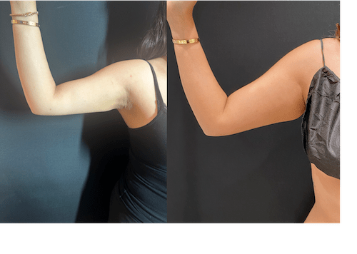 nps_before-after-arm-lipo-6-2023-1-min