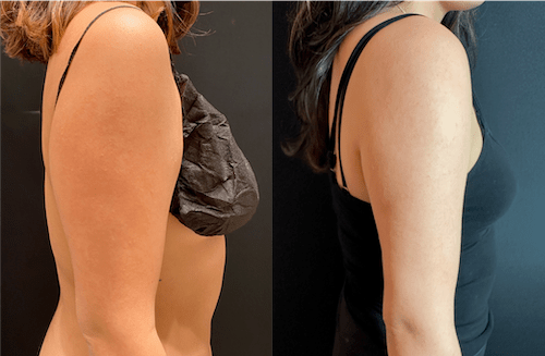nps_before-after-arm-lipo-6-2023-2-min