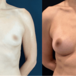 nps_before-after-breast-augmentation-13-1-min