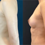 nps_before-after-breast-augmentation-13-2-min