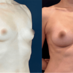 nps_before-after-breast-augmentation-13-3-min