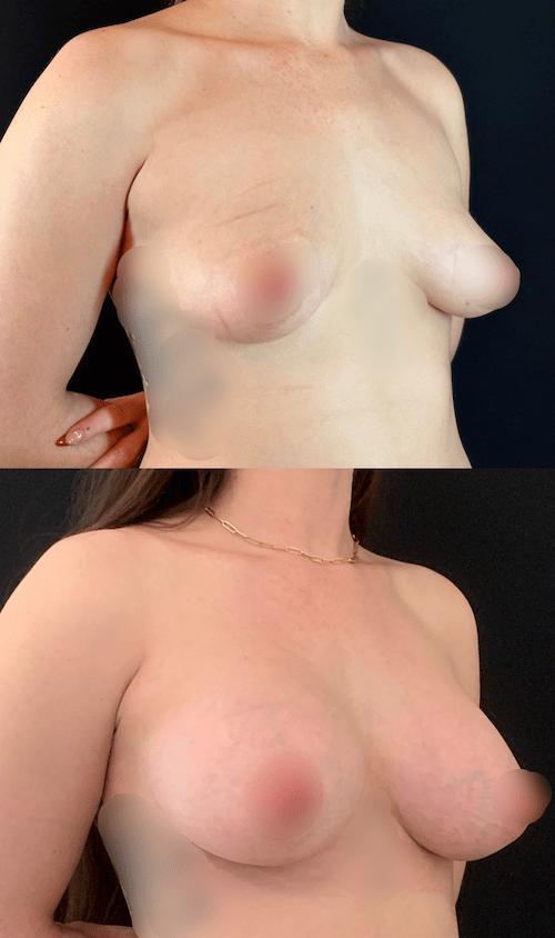 Different Breast Shapes - Neinstein Plastic Surgery