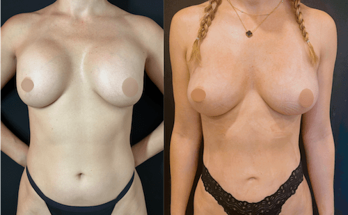 nps_before-after-breast-revision-7-min (1)