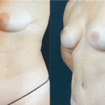 nps_before-after-tummy-tuck-breast-aug-min