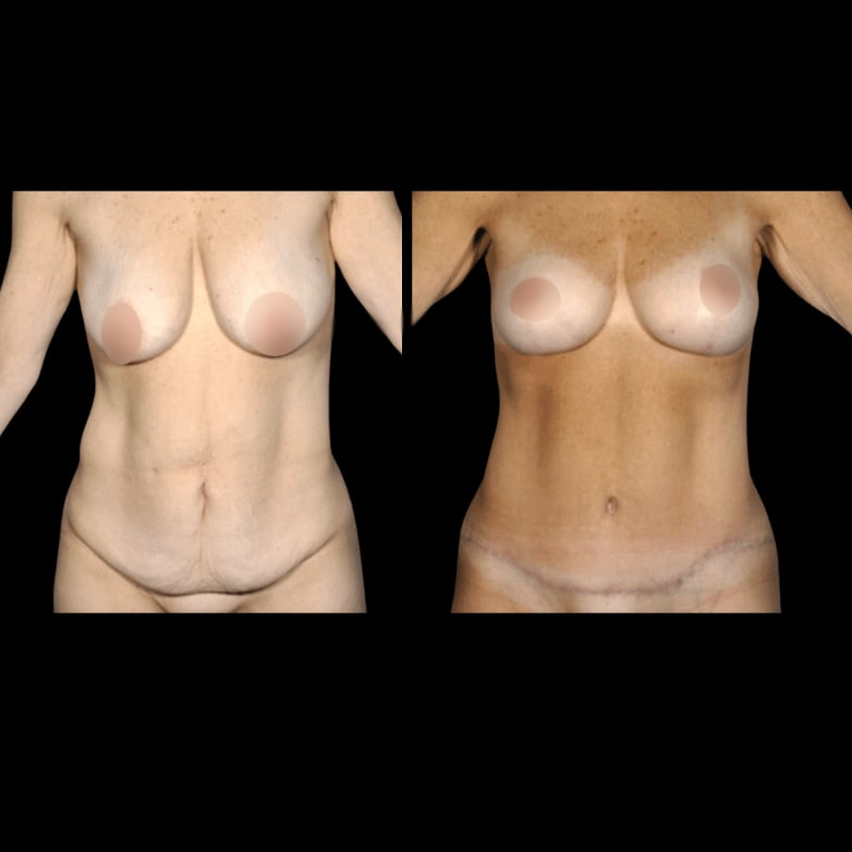 nps_before-after-breast-lift-1-min-min
