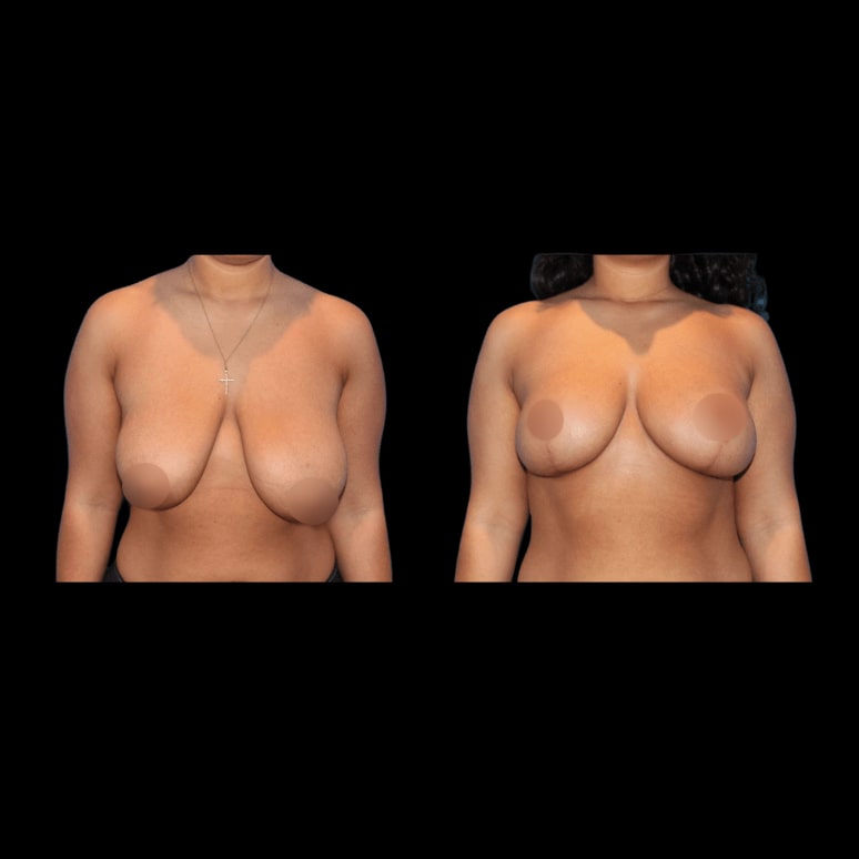 nps_before-after-breast-lift-4-min-min