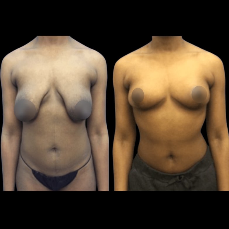 nps_before-after-breast-lift-5-min-min