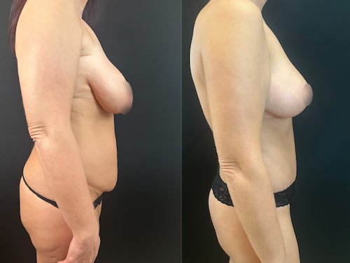 nps_before-after-breast-lift-9.27-2-min
