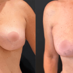 nps_before-after-breast-implant-removal-10-min