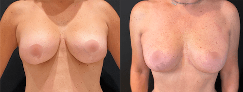 nps_before-after-breast-implant-removal-10-min