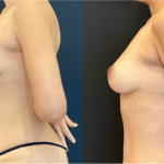 nps_before-after-breast-lift-10.4-min