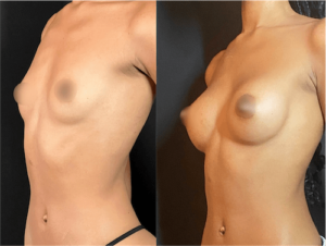 nps_before-after-breast-lift-augmentation-14-min
