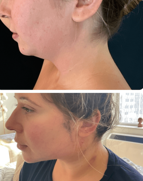 nps_before-after-chin-jaw-12.7-min