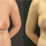 nps_breast-lift-before-after-1.1-min