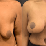 nps_breast-lift-before-after-1.2-min
