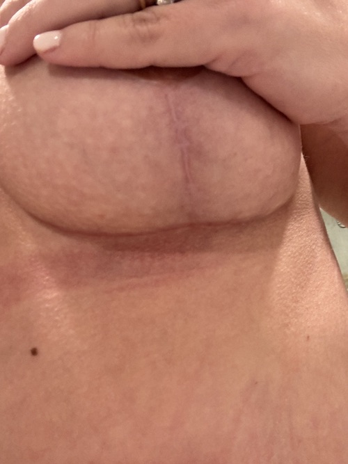 nps-breast-lift-scar
