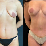 nps_breast-life-before-after-3.19-1