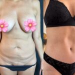 nps_breast-revision-tummy-tuck-before-after
