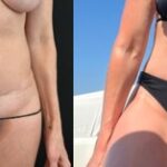 nps_complex-revision-tummy-tuck-before-after