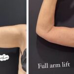 nps_full-arm-lift-before-after