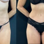 nps_tummy-tuck-before-after-1