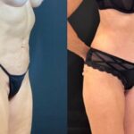 nps_tummy-tuck-before-after-2