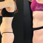 nps_tummy-tuck-before-after-2-3.29