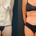 nps_tummy-tuck-before-after-3-3