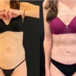 nps_tummy-tuck-before-after-3.29