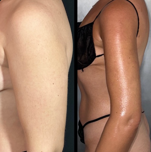 before-after-arm-lipo