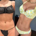 nps_before-after-lipo360