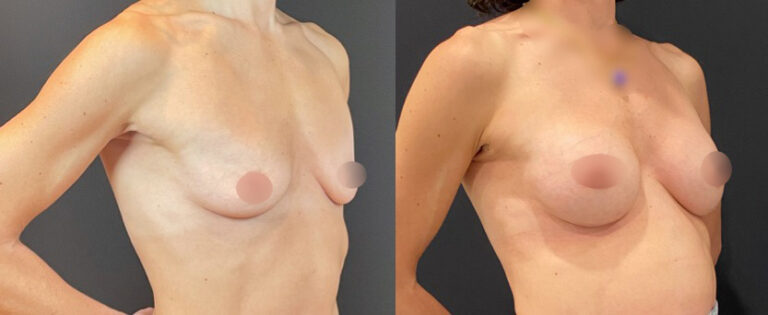 nps_before-after-breast-aug-10-4