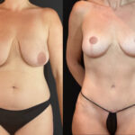 NPS_before-after-breast-tummy-mommy-2