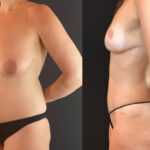 NPS_before-after-breast-tummy-mommy-2