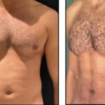 male-body-contouring-1