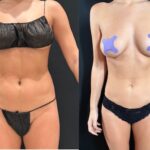 nps_lipo-360-before-after-12.20-1