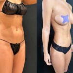 nps_lipo-360-before-after-12.20-1