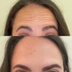 NPS_injectable-before-after-4.25